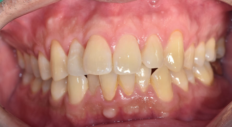 고덕역 교정치과 40대인데 치아 교정 가능한가요? 관련 이미지 2