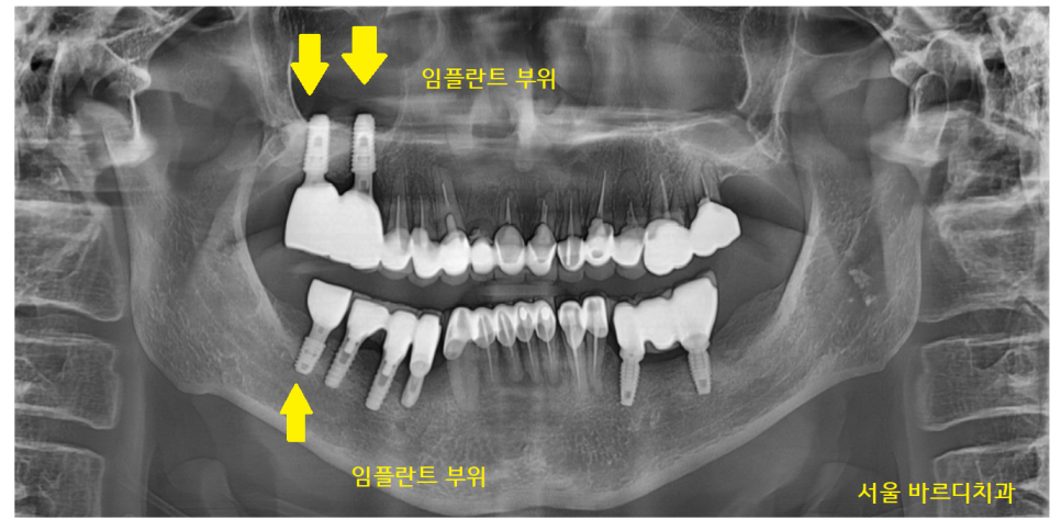 명일동 치과 뿌리 염증으로 입냄새가 나요 해결책은? 관련 이미지 9