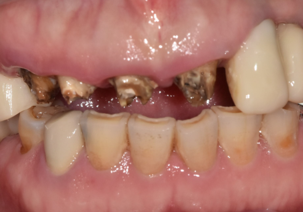 고덕동 어금니 브릿지 교체, 관련 이미지 3