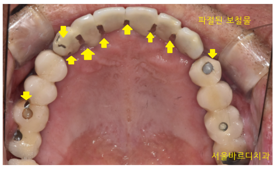 덕풍동 치과 오래된 임플란트 제거 후 재식립하였습니다. 관련 이미지 5