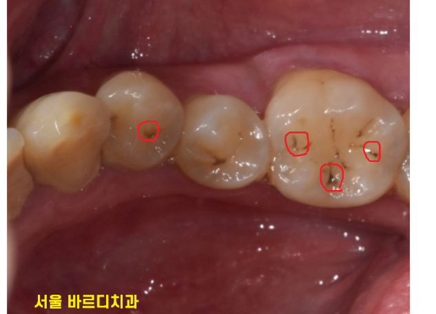 강동구 치과 충치는 전염될까?? 다른 치아로 옮겨갈까? 관련 이미지 5