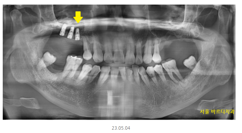 길동 치과 임플란트 뼈이식 흡연 관련 있을까? 관련 이미지 6