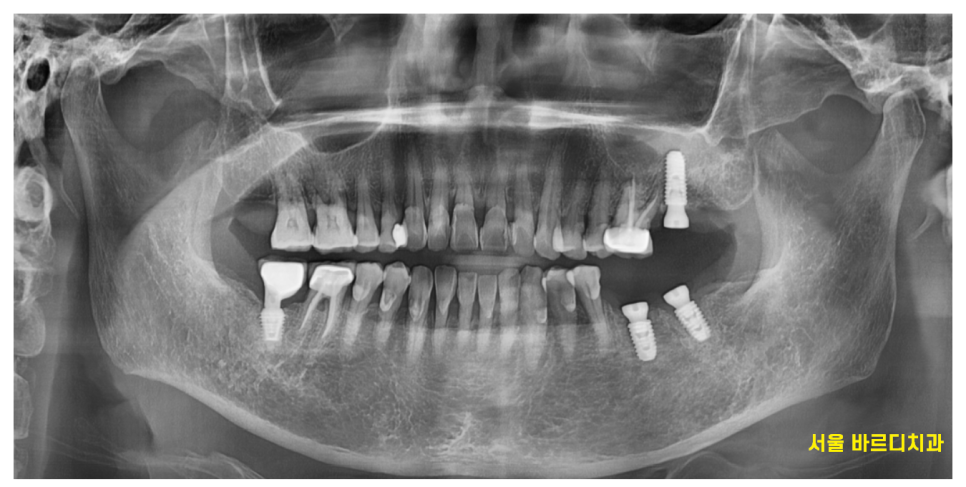 고덕동 치과 어금니 흔들림과 통증 임플란트가 답일 때! 관련 이미지 8