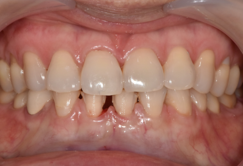 앞니 레진 떨어짐, 자꾸 반복된다면 관련 이미지 8