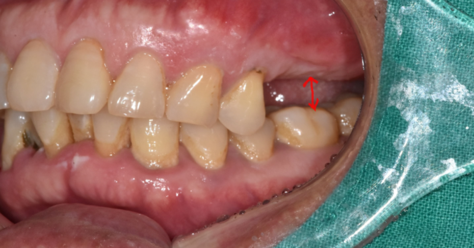 하남 미사 치과 치아 방치하다 올라옴 케이스 보여드립니다. 관련 이미지 6
