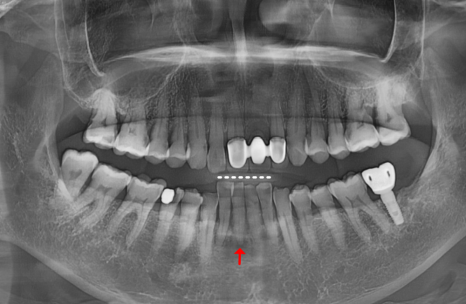 솟구치는 앞니, 흔들리는 치아가 보내는 관련 이미지 1