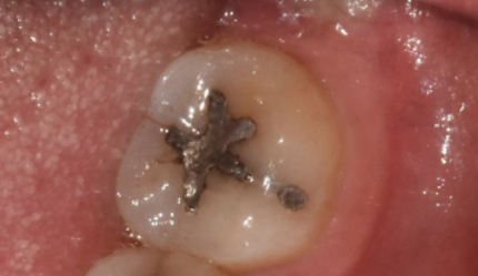 치아 땜질 다 떼울 수는 없지만..강동구 치과에서는 이렇게 합니다. 관련 이미지 7