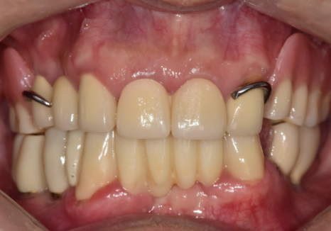 Godeok-dong Tooth Fracture: Check This Before Getting an Implant! Revealing the Criteria for Saving It image 8