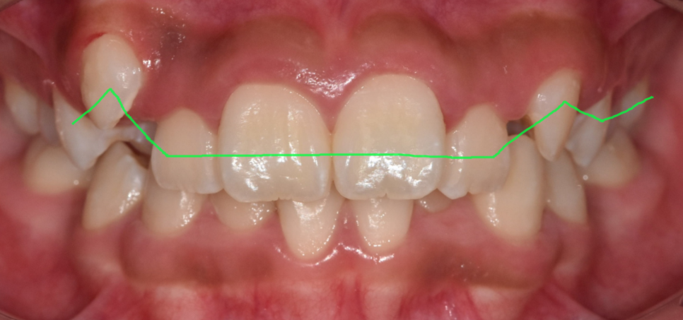 How to Correct a Canine Crowding Malocclusion: Extractions Are Necessary to Address Lip Protrusion image 3