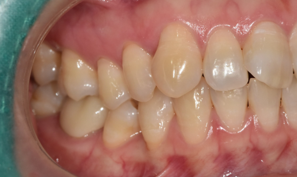 나비 모양 앞니 2가지 방법으로 개선 가능합니다. 관련 이미지 6