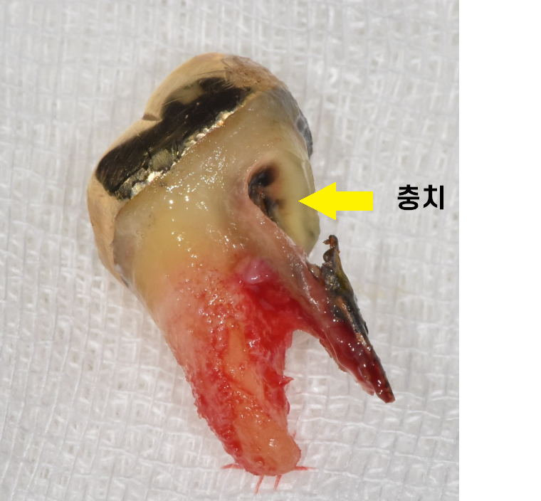 천호동 임플란트 치아 뿌리 충치가 파절을 유발하다. 관련 이미지 5