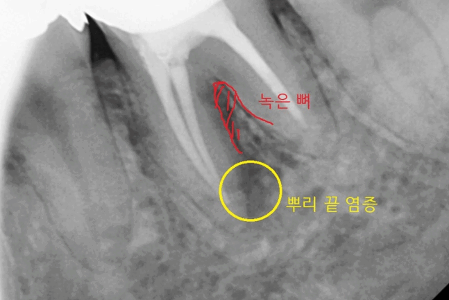 감일동 치과 첫번째 임플란트 시작이 중요합니다. 관련 이미지 1