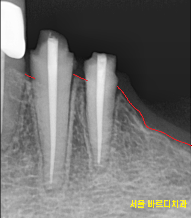 강일동 치과추천 틀니 사용중 치아 부러짐 임플란트로 복구했습니다. 관련 이미지 5