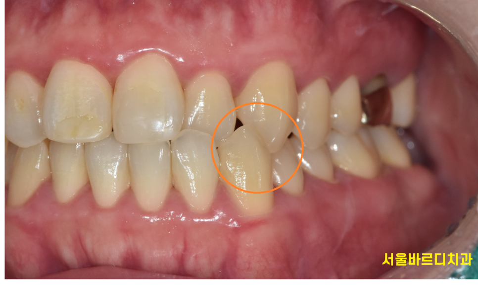 길동 치아교정 통증 겪어보지 않았기에 어느정도일까? 관련 이미지 2