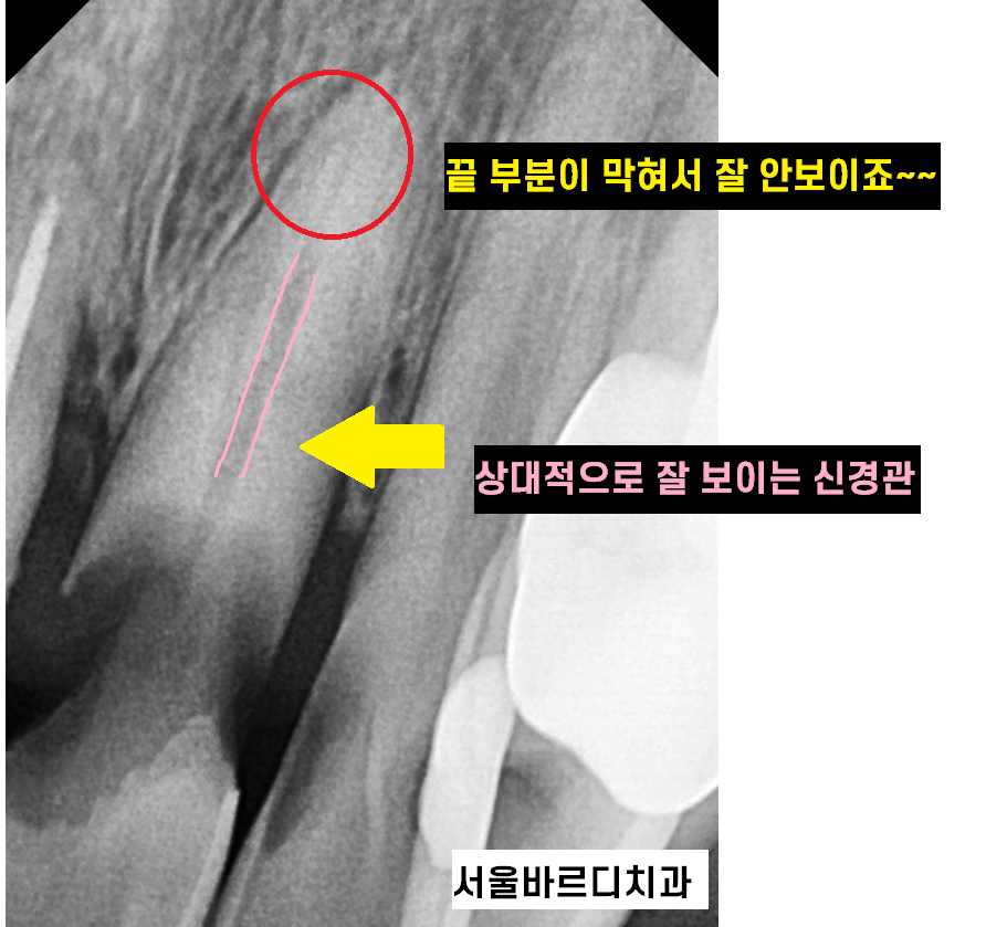 입 마름 치근 우식증이 쉽게 생길 수 있습니다!! 관련 이미지 5