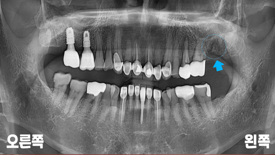 서울바르디치과 뿌리 끝 염증 심한 치아를 네비게이션 임플란트 #6 관련 이미지 5