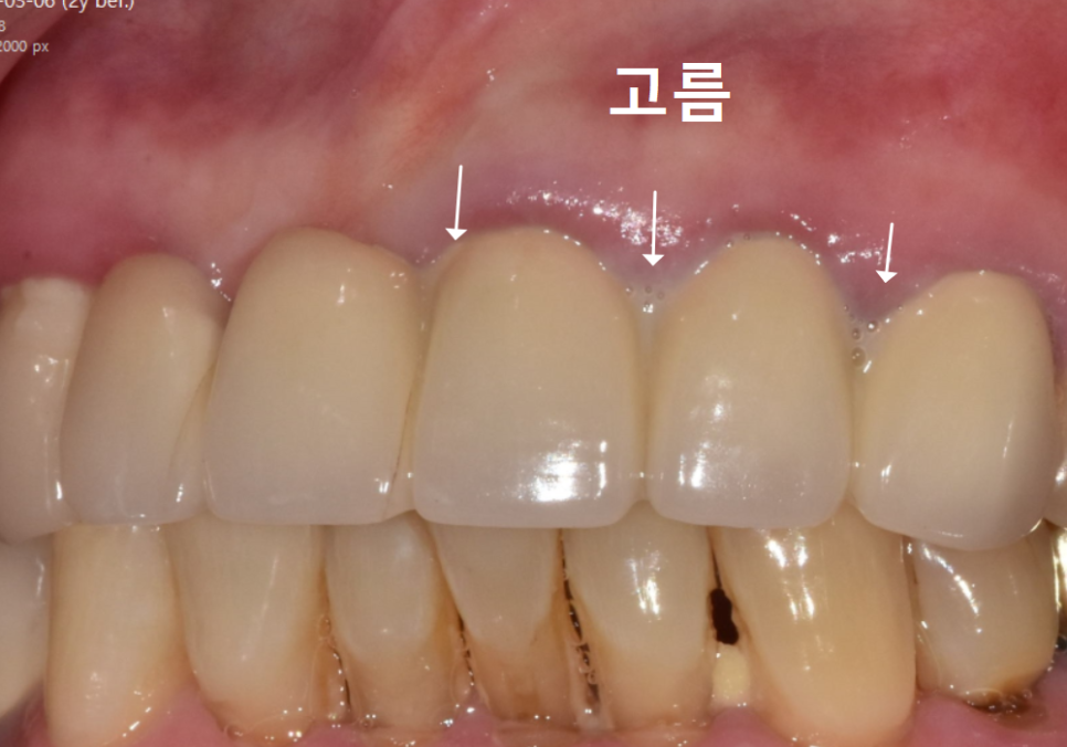 앞니 고름, 잇몸약을 먹어도 왜 염증이 가라앉지 않을까요? 관련 이미지 6