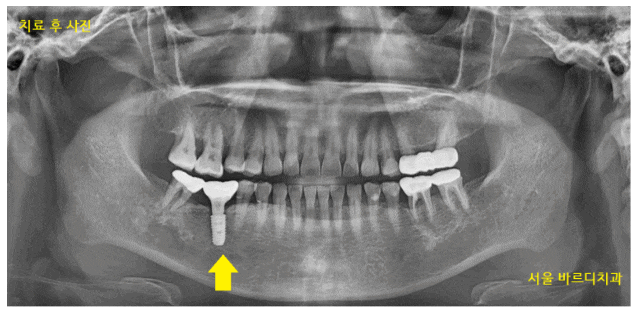 강동구 치과 약먹는게 많은데 임플란트 수술 할 수 있나요?? 관련 이미지 1