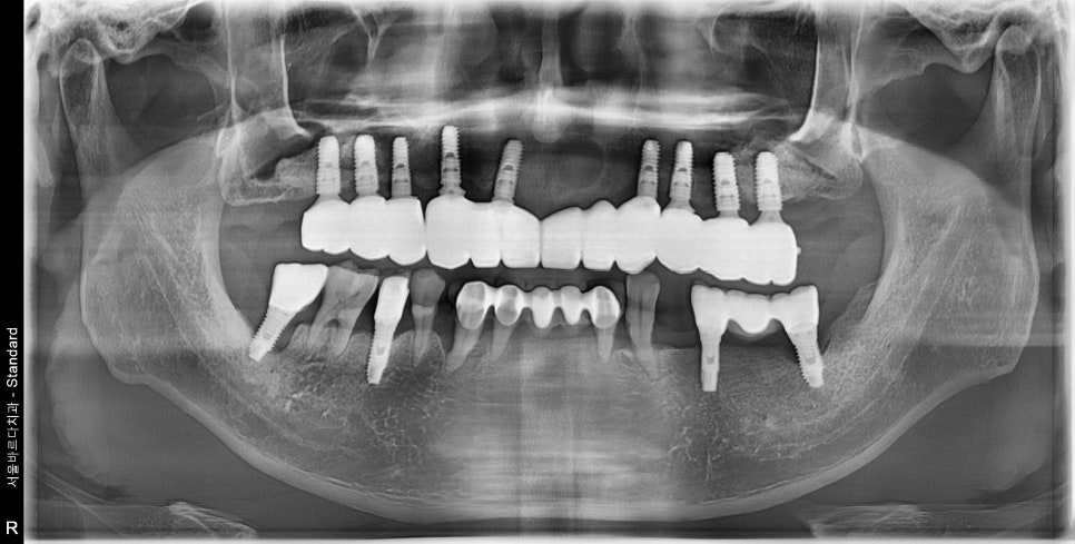 얇은 잇몸뼈, 임플란트 거부 당했다면? 상악동거상술로 해결할 수 있습니다. 관련 이미지 14