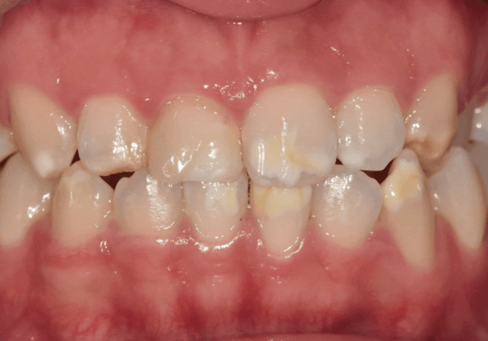 앞니 변색, 치아미백효과 없는 이유 솔직하게 말씀드립니다. 관련 이미지 3