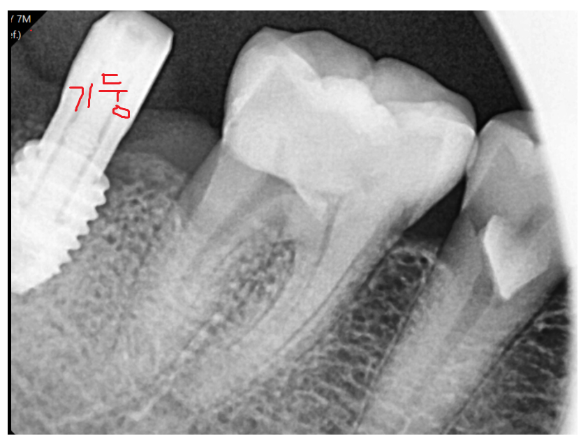 덕풍동 치과 잇몸 욱신 욱신 원인 찾아 임플란트 수술하였습니다. 관련 이미지 9