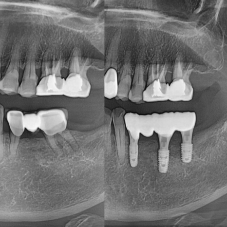 Godok Implant: Treatment That Reduced the Financial Burden with Insurance Implants for a Patient in Their 70s image 7