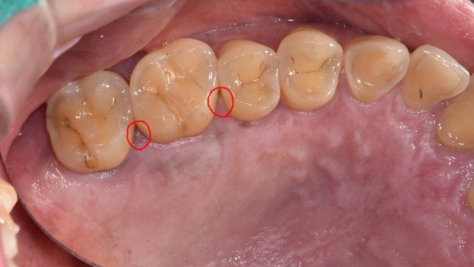 고덕동 치과 심한 치주염에는 oooo 치료가 제격입니다!! 관련 이미지 1