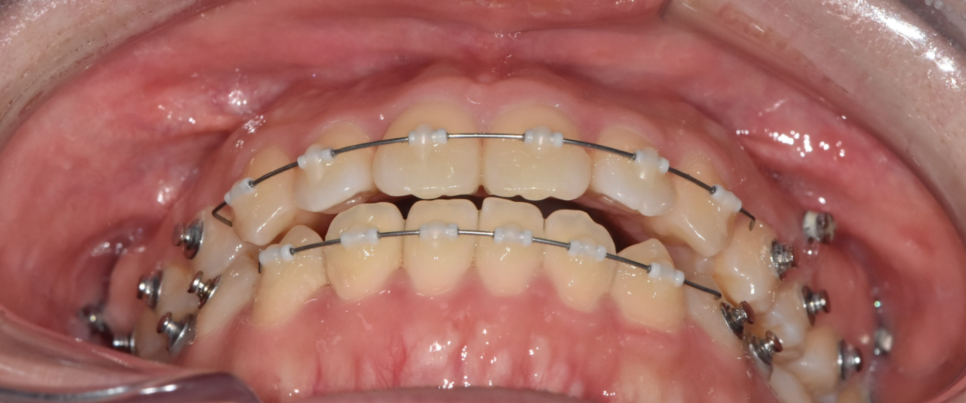 mta 장치 교정 앞니만 빠르게 심미적으로 정리할 수 있습니다. 관련 이미지 4