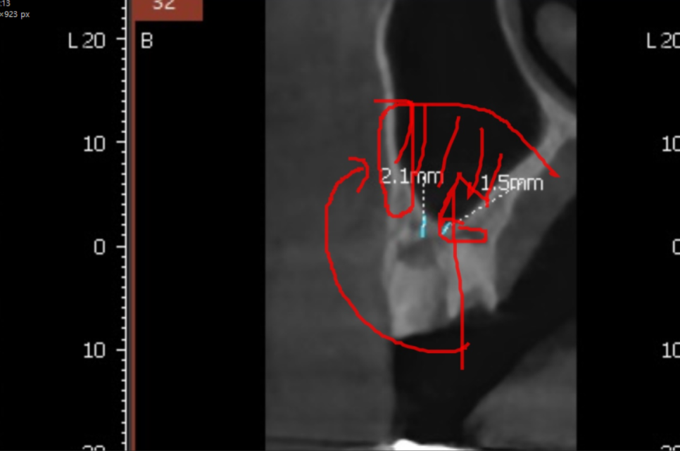 풍산동 치과 임플란트 양쪽 치료 가능한가요? 관련 이미지 10