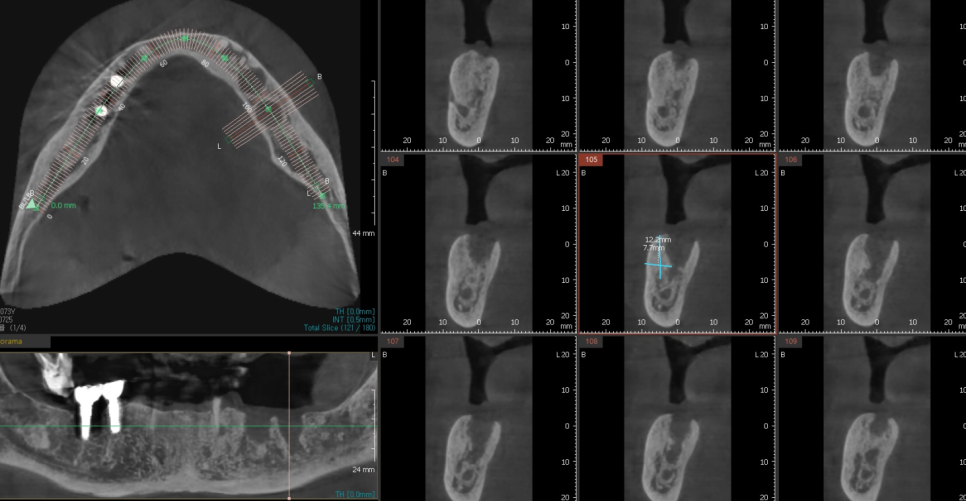 천호동 치과 자연 발치 후 방치된 치아 임플란트 케이스 관련 이미지 6