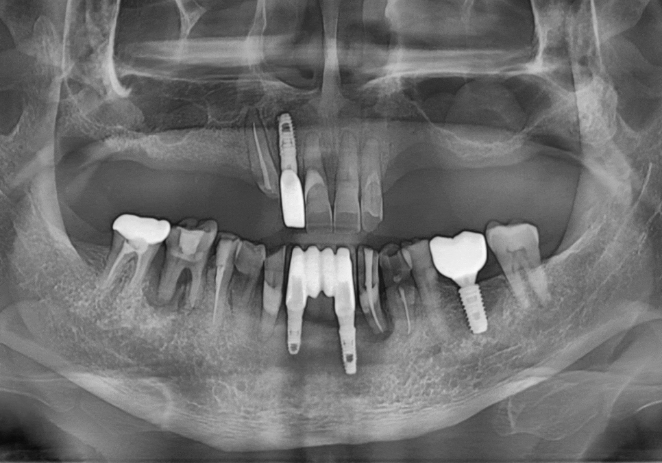 Cheonho Dental Clinic, Are You Over 65? We’re Revealing How to Reduce Denture and Implant Costs. image 7