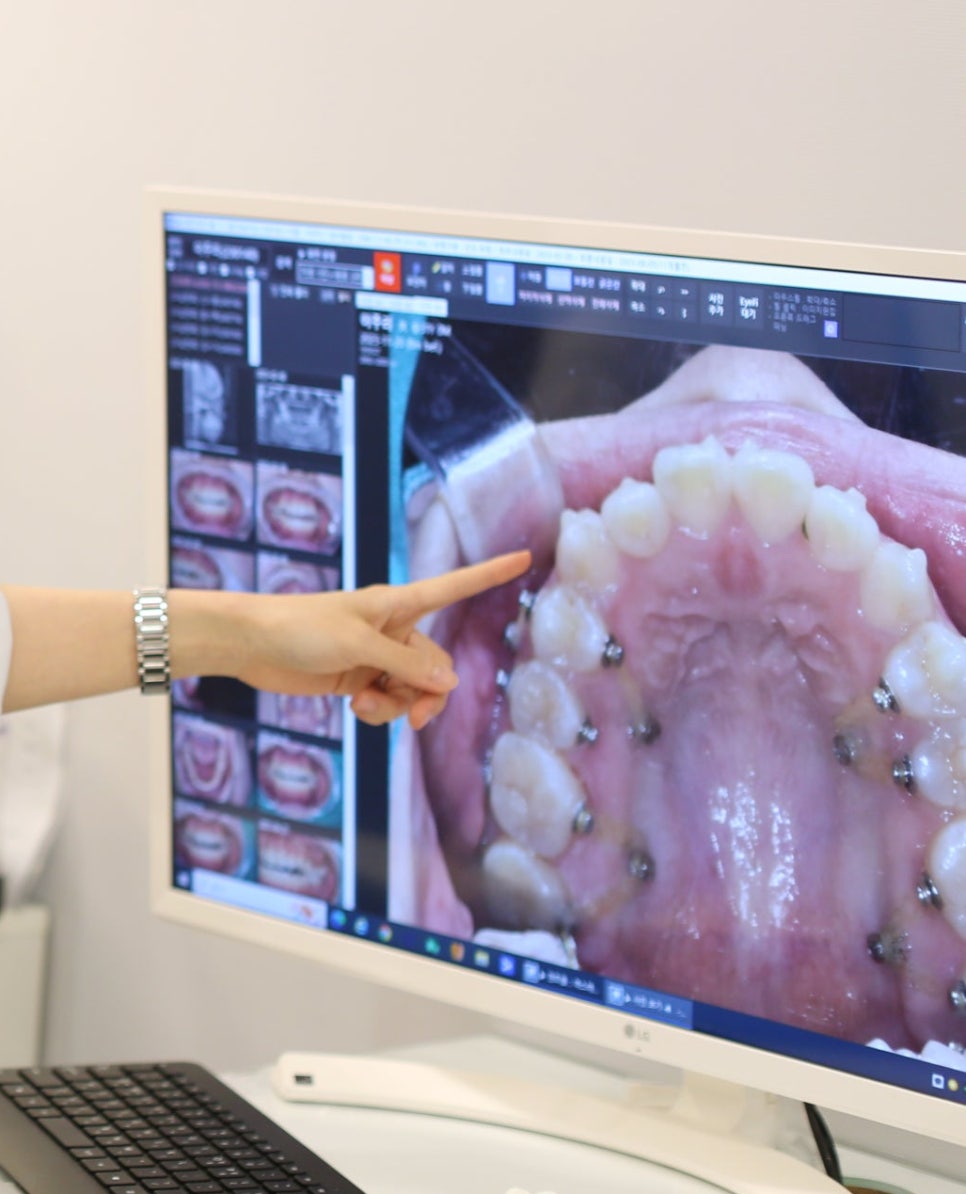 상일동 라미네이트 과연 진짜 안좋을까??? 교정, 크라운과 비교해보았습니다!! 관련 이미지 4