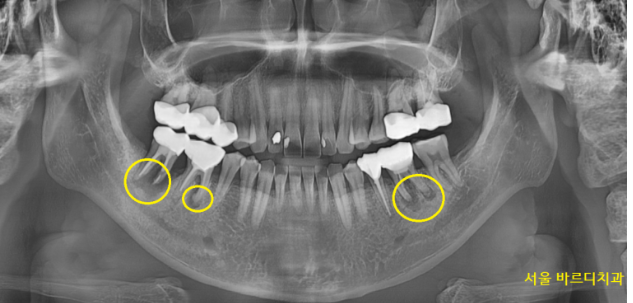 상일동치과 비가역적 치수염 치아 심폐소생했습니다. 관련 이미지 2