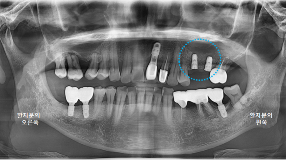 고덕동치과 서울바르디치과 전치부 및 구치부 임플란트 치료증례 #9 관련 이미지 31