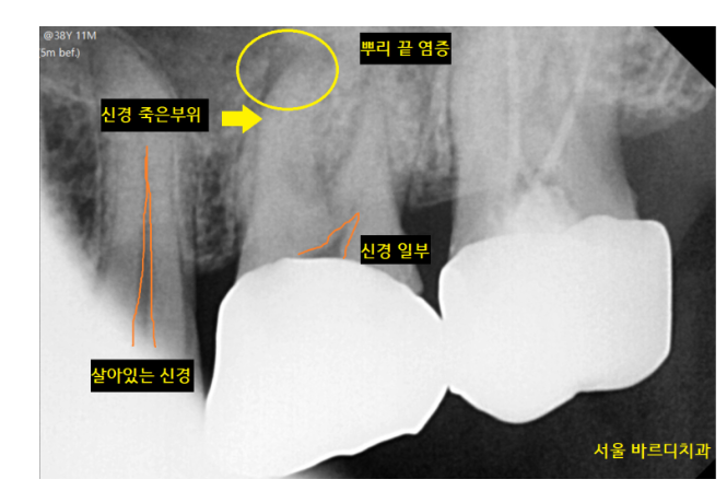 뜨거운 물 시큰 오히려 위험한 신호입니다!! 관련 이미지 4