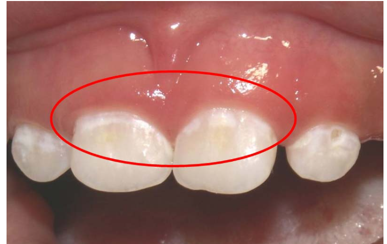 치아에 생긴 하얀 얼룩, 왜 생기나요? 초기 충치일 수 있습니다. 관련 이미지 4