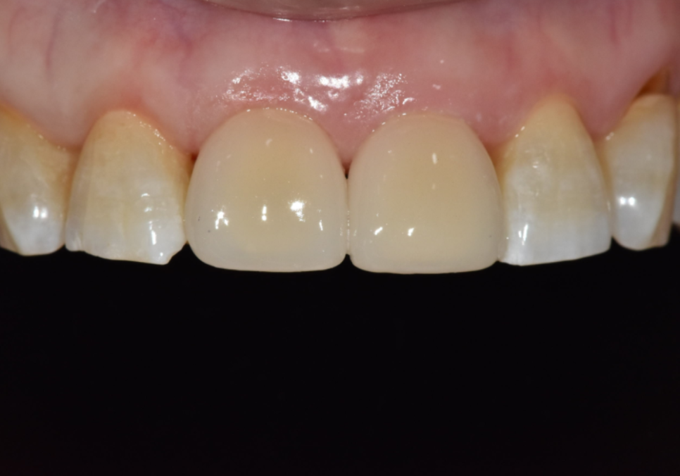 앞니 끝부분 깨짐, 다듬기, 레진, 라미네이트? 어떤 치료가 나에게 적합할까? 관련 이미지 13