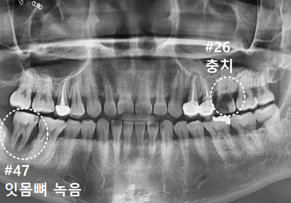 어금니 구멍, 충치 솔직하게 말씀드립니다. 치과 공포증으로 미루신 분들 필독 관련 이미지 1