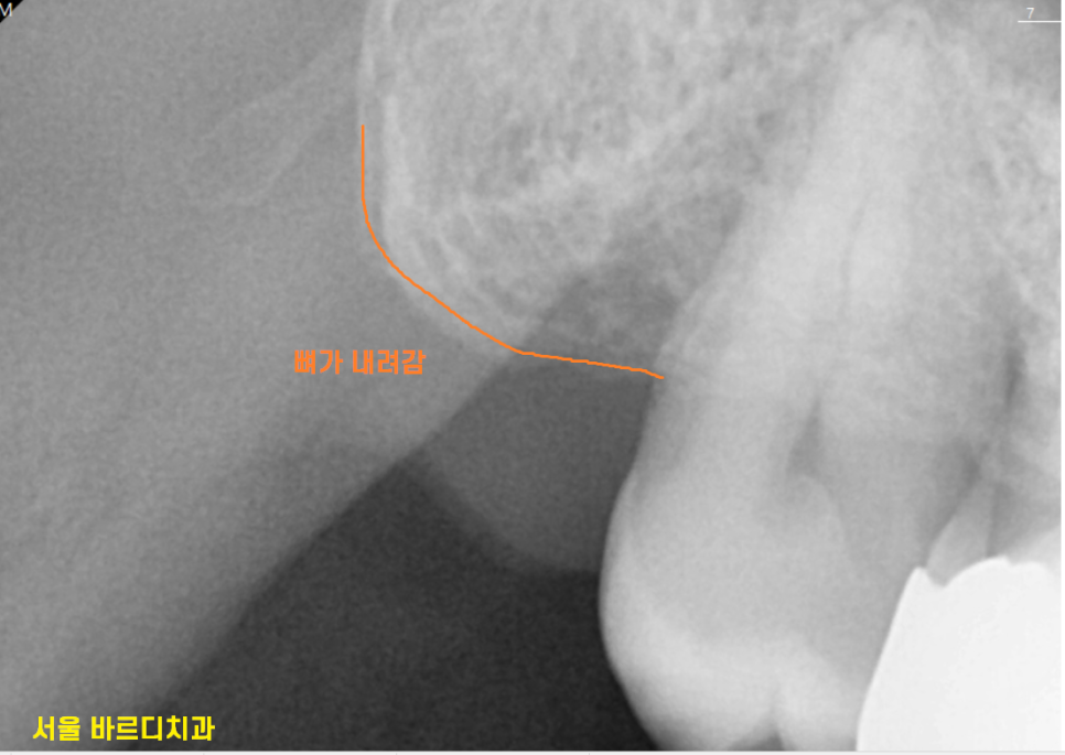 강동구 임플란트 뿌리 염증 심해질경우 대처 방법 관련 이미지 3