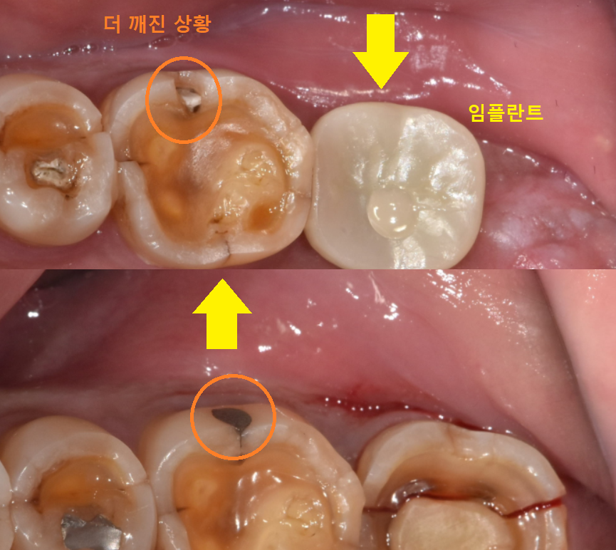 어금니 금감 발치 후 임플란트 풍산동 치과에서 진행했습니다. 관련 이미지 9