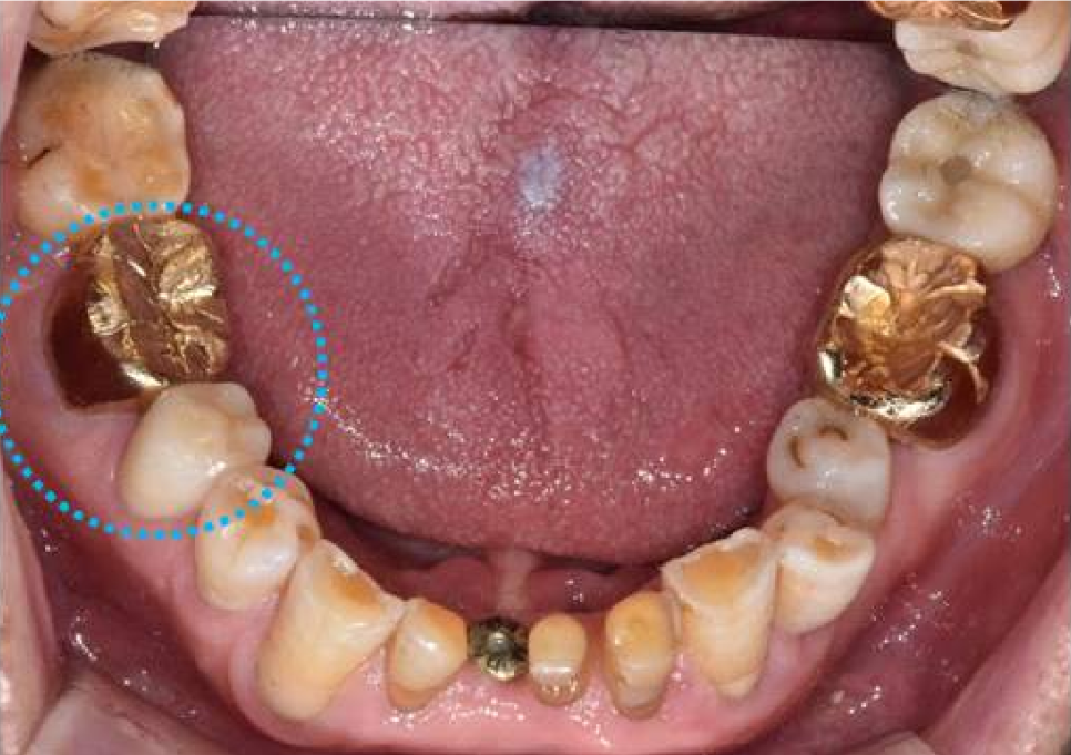 서울바르디치과 상하악 대구치 네비게이션 임플란트 치료증례 #4 관련 이미지 3
