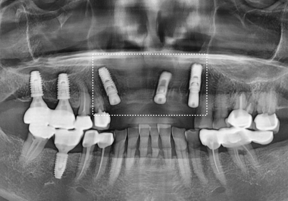 앞니 고름, 잇몸약을 먹어도 왜 염증이 가라앉지 않을까요? 관련 이미지 10