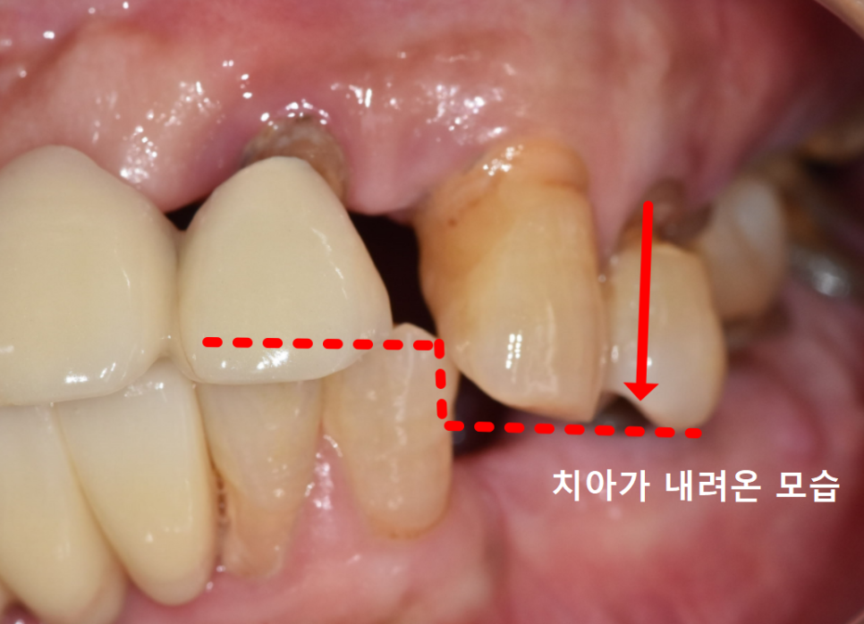 고덕동치과, 보험 임플란트? 추가 비용이 왜 나오는 거죠? 관련 이미지 4