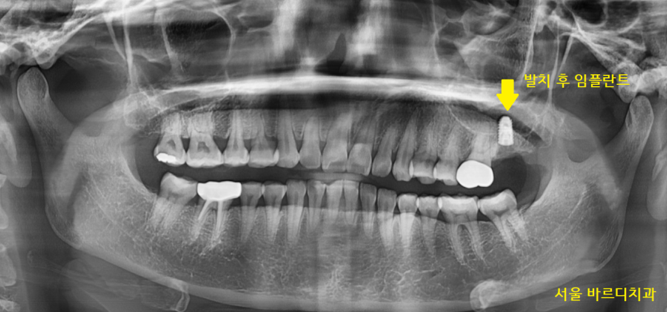 미사역 치과 어금니 뿌리 쪼개짐으로 발치 후 임플란트 했습니다! 관련 이미지 6