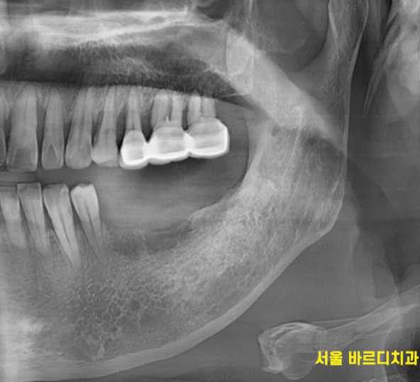 상일동역 치과에서 알려드리는 임플란트 수술과정 대공개 관련 이미지 2