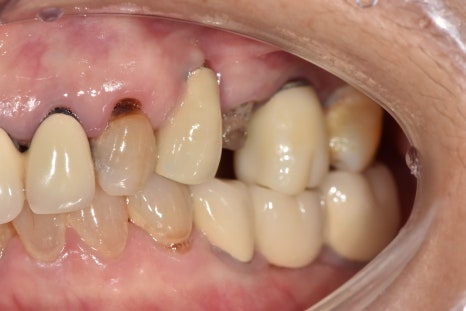 A Case of a 69-Year-Old Who Underwent Immediate Implant Placement After Extraction Due to Tooth Decay in Godeok-dong image 5