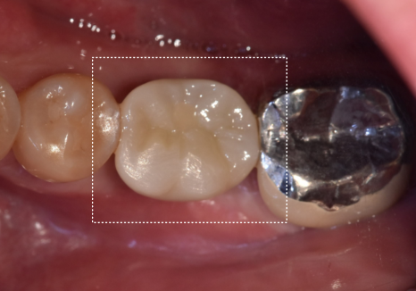 Honestly, Can an Unbroken Temporary Tooth Be Used Without a Crown? image 15