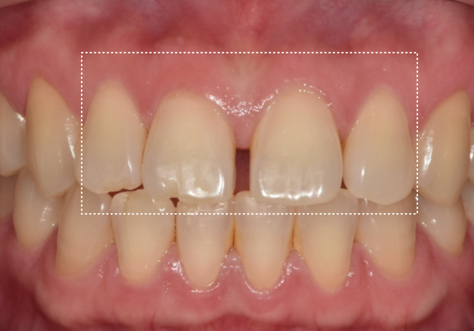 무삭제 라미네이트 적응증, 당신이 미처 몰랐던 시술의 조건을 공개합니다. 관련 이미지 10