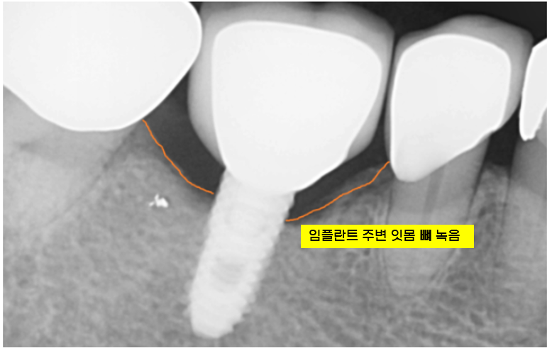 고덕동 치과 임플란트도 교체 주기가 있을까? 기준은? 관련 이미지 3