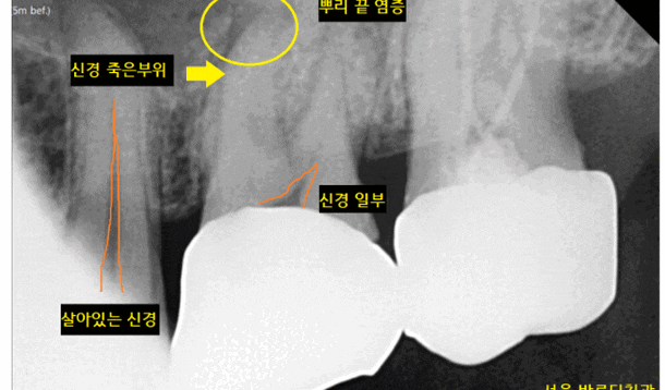 상일동치과 비가역적 치수염 치아 심폐소생했습니다. 관련 이미지 1